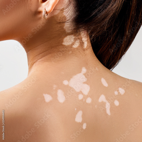 Rear view on female back with vitiligo. photo