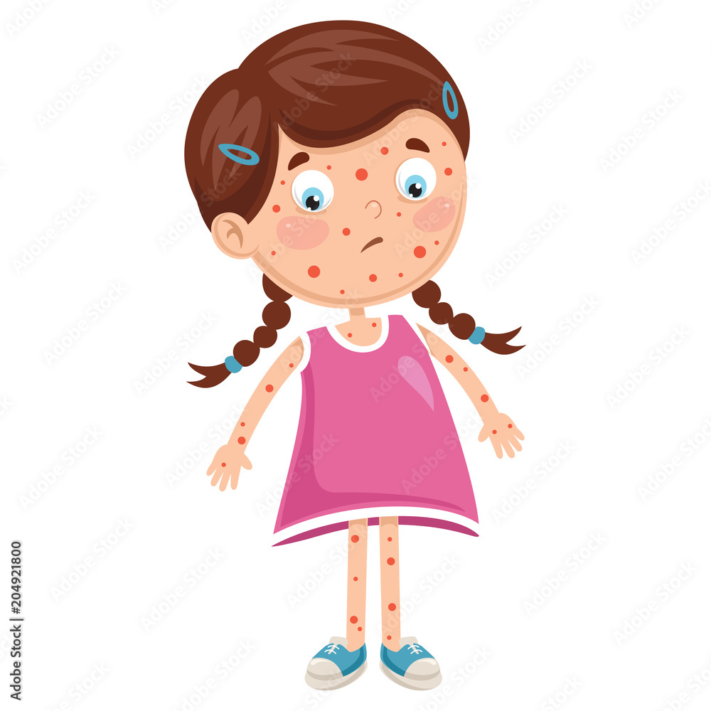 Vector Illustration Of Child Diseases Vector Illustration Of Child Diseases