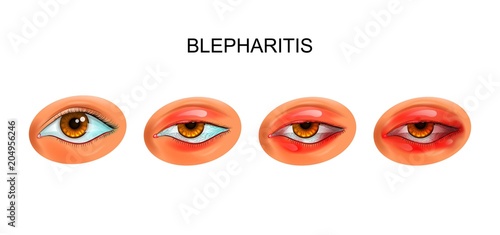 inflammation of the eyelids. blepharitis photo