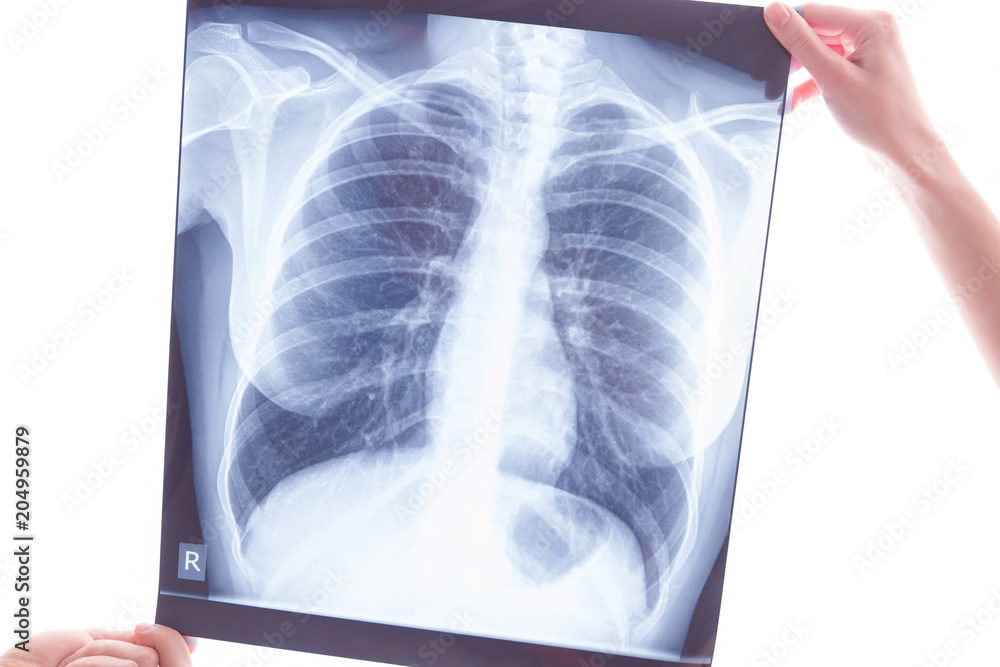 Oncological disease concept. Hands holding x-ray of lungs examining lung cancer Oncological disease concept. Hands holding x-ray of lungs examining lung cancer
