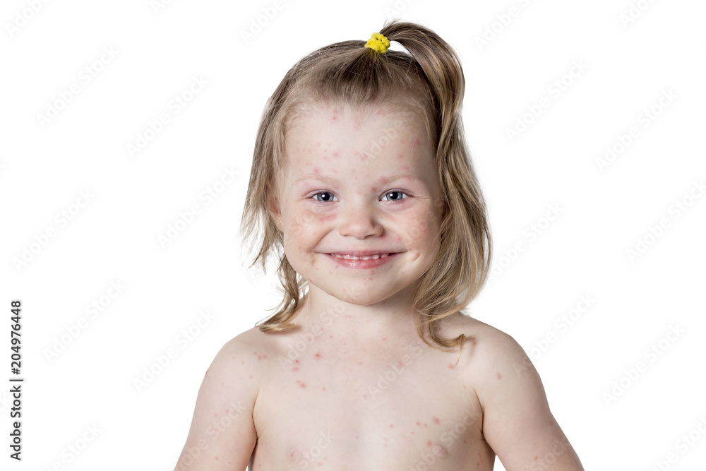 Portrait of beautiful little girl with pimples of chickenpox on her