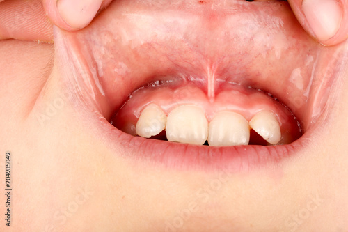 Fotografija the bridle of the upper lip in the child close up