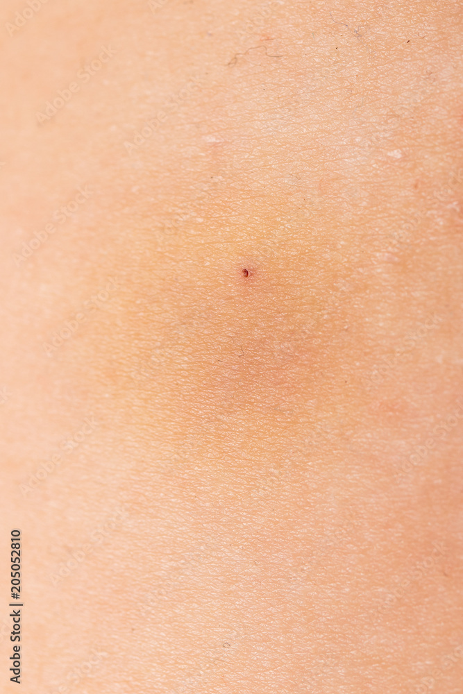 A bruise on the skin of a man A bruise on the skin of a man