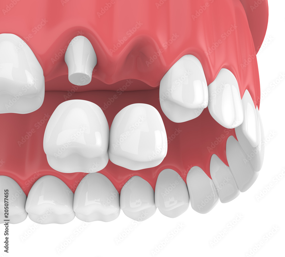 3d render of dental cantilever bridge with crowns in upper jaw 3d render of dental cantilever bridge with crowns in upper jaw