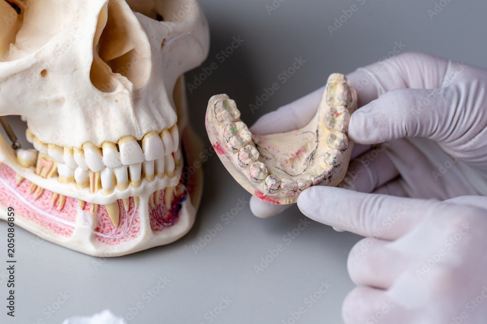 Study cast of Diagnostic cast and dental gypsum models in dental