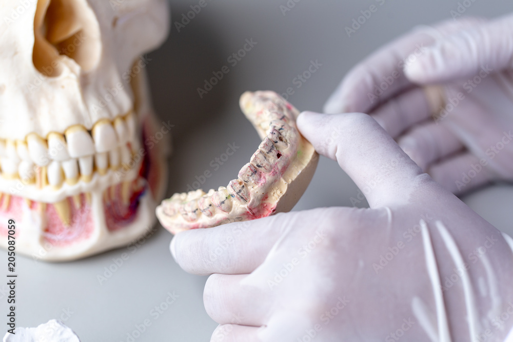 Study cast of Diagnostic cast and dental gypsum models in dental