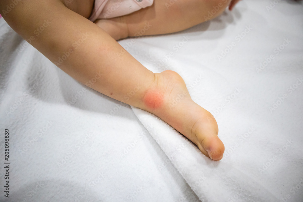 closeup insect bites on baby leg with red allergy spot closeup insect bites on baby leg with red allergy spot