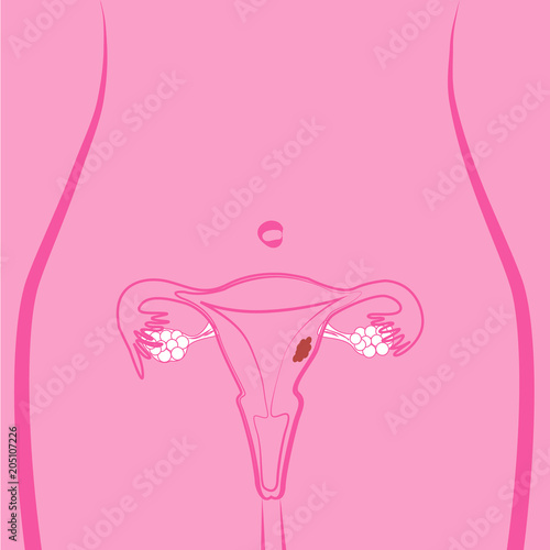Uterine Fibroid vector illustration