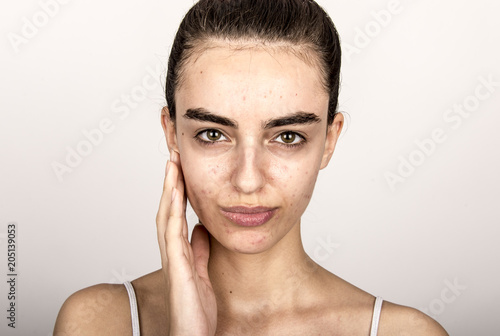 Photography beautiful young girl with problematic skin, acne problem concept