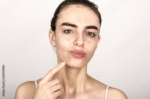 Картината върху платно beautiful young girl with problematic skin, acne problem concept