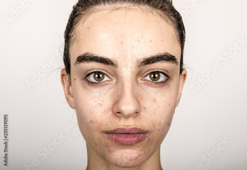 beautiful young girl with problematic skin, acne problem concept