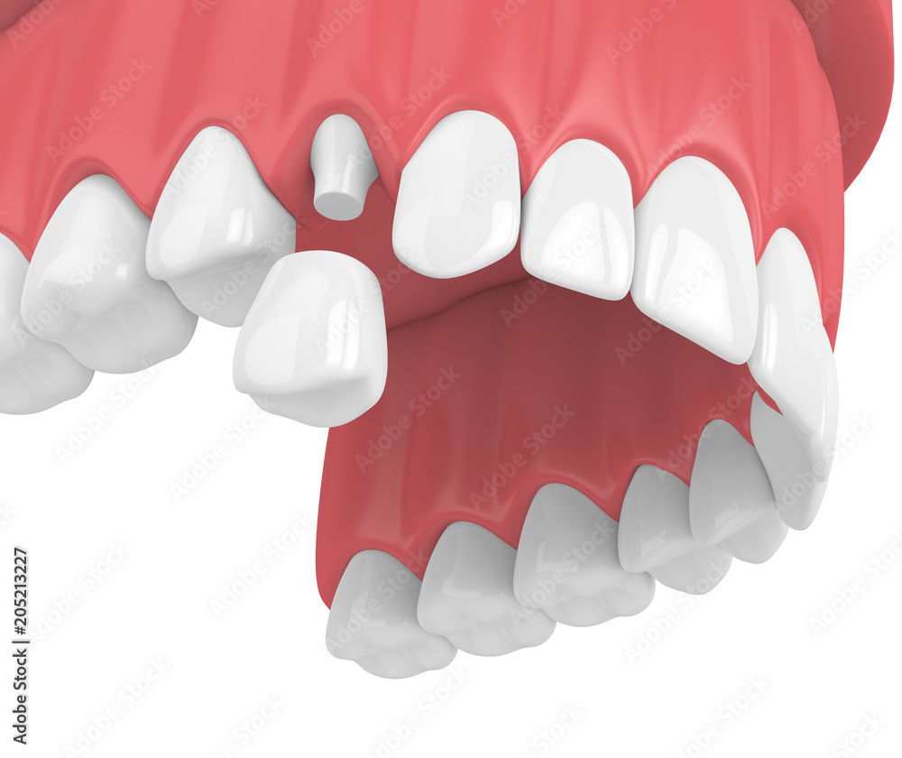 3d render of upper jaw with teeth and dental premolar crown 3d render of upper jaw with teeth and dental premolar crown