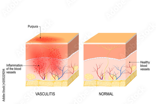 Vasculitis. Cross section of the human skin with vasculitis