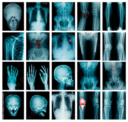 collection x-ray image skull, shoulder, hip, knee joint , scoliosis spinne and small joint in content photo