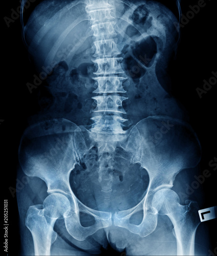 Photography x-ray lumbar spine show degenerative change of disc and body of spine