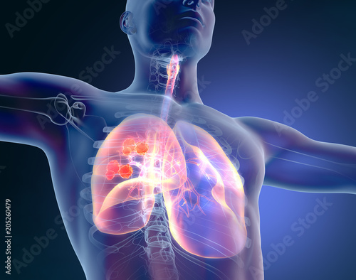 Lung cancer, medical illustration