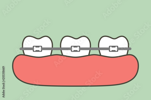 orthodontic teeth or dental braces