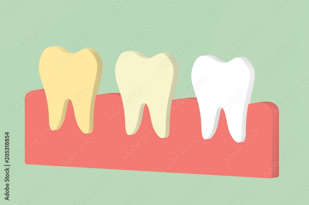 yellow to white tooth, teeth whitening concept yellow to white tooth, teeth whitening concept