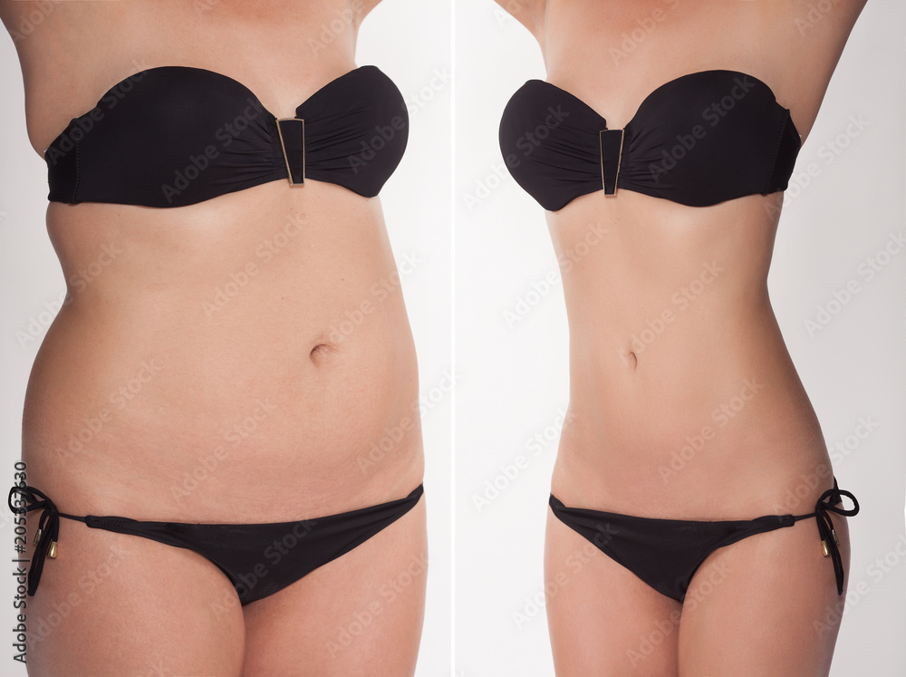 Comparison before and after losing weight. A fat and thin girl in a bikini.  foto de Stock | Adobe Stock