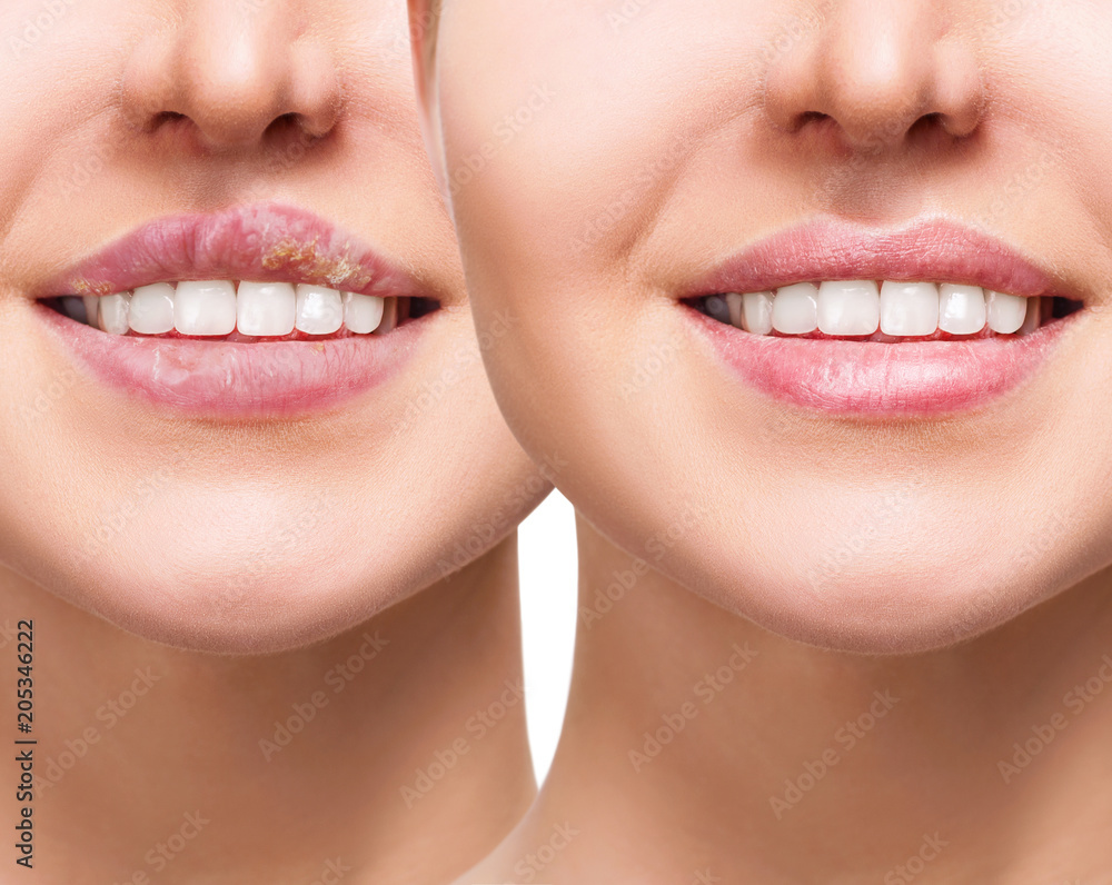 Herpes Pictures Female Lips