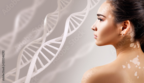 Young sensual woman with vitiligo disease in DNA chains. photo