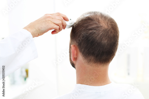 Mikroskopowa analiza stanu włosów i skóry głowy. Głowa mężczyzny z przerzedzonymi włosami podczas badania skóry głowy i włosów mikroskopem