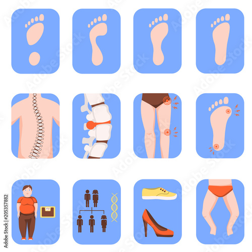 Fallen arches or flat foot icons set isolated on white background. Orthopedic disease, causes and symptoms. Health care concept. Color vector illustration
