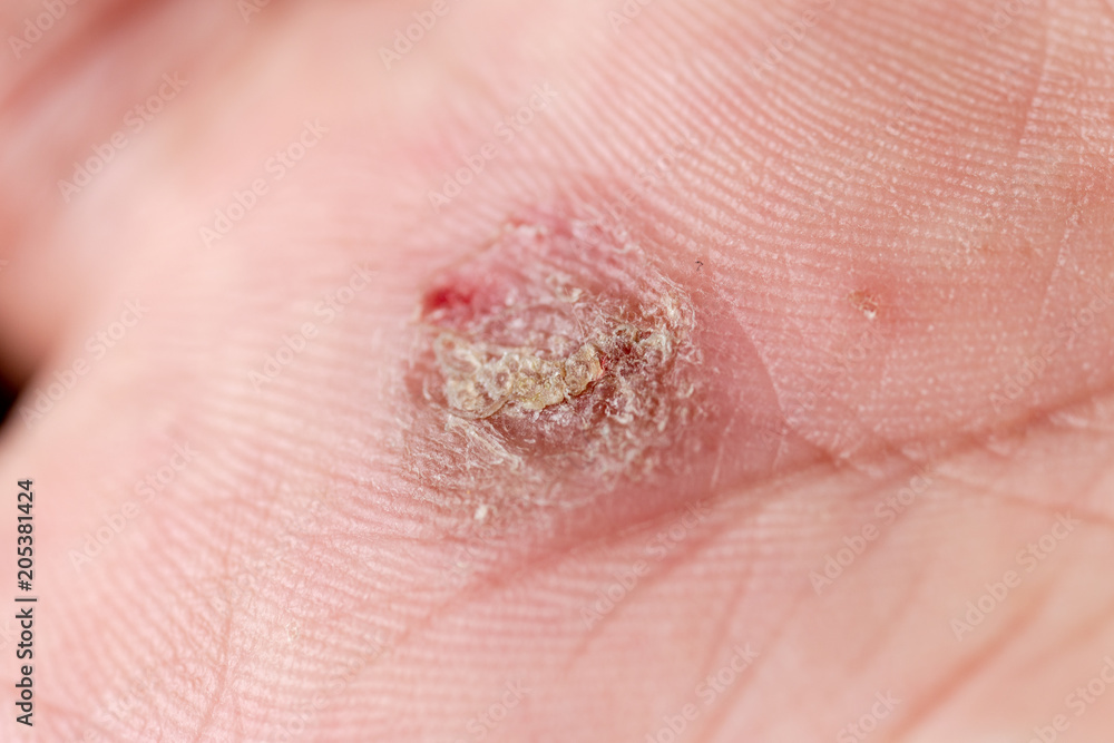 Atopic dermatitis (AD), also known as atopic eczema, is a type of inflammation of the skin (dermatitis). Atopic dermatitis (AD), also known as atopic eczema, is a type of inflammation of the skin (dermatitis).