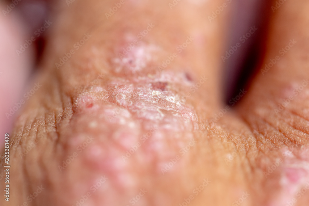 Atopic dermatitis (AD), also known as atopic eczema, is a type of inflammation of the skin (dermatitis). Atopic dermatitis (AD), also known as atopic eczema, is a type of inflammation of the skin (dermatitis).