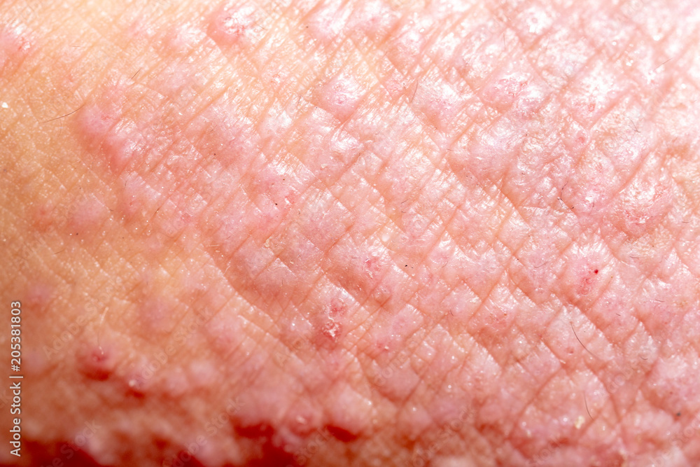 Atopic dermatitis (AD), also known as atopic eczema, is a type of inflammation of the skin