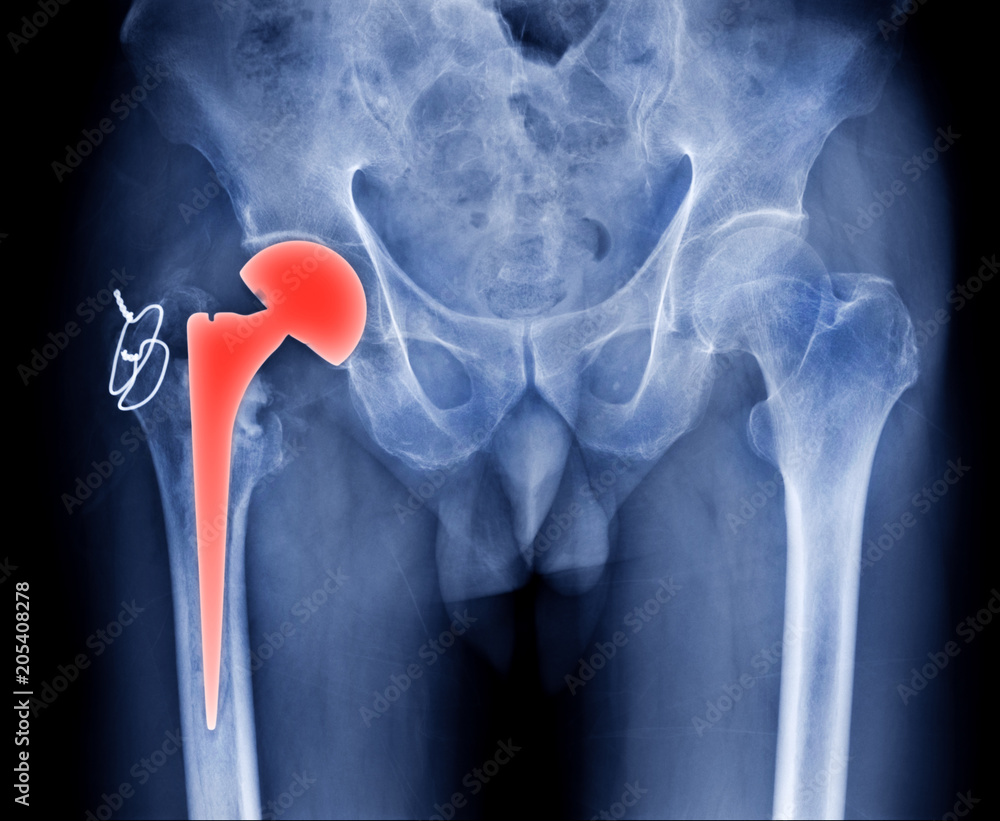 hip replacement xray image, high quality of hip and pelvic bone og old woman show internal