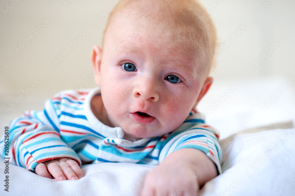 Allergies, atopic dermatitis on the face of a baby Allergies, atopic dermatitis on the face of a baby
