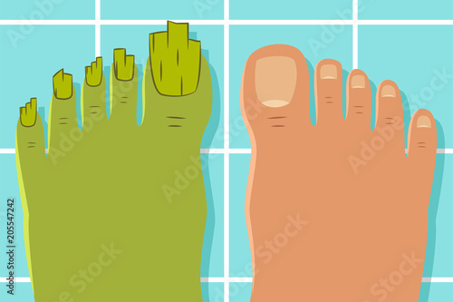 Ugly toes with a fungus. Vector illustration of a healthy and diseased foot isolated on background.