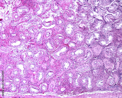 Принти на полотні Testicular atrophy. Klinefelter syndrome