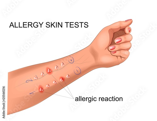 scarification tests for allergies photo