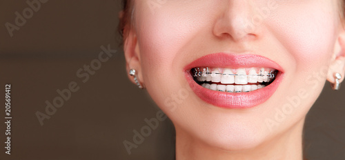 Foto Braces on Teeth