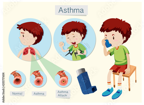 A Human Anatomy and Health Asthma