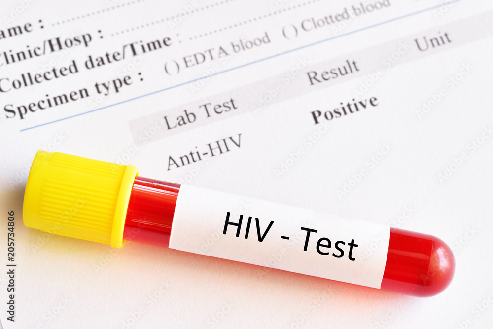 Obraz premium HIV positive test result with blood sample tube 
