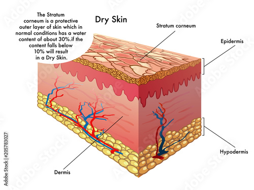 vector medical illustration of the effects of dry skin
