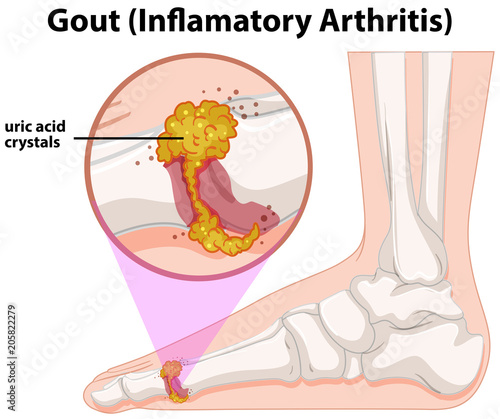 A Medical Human Anatomy Gout
