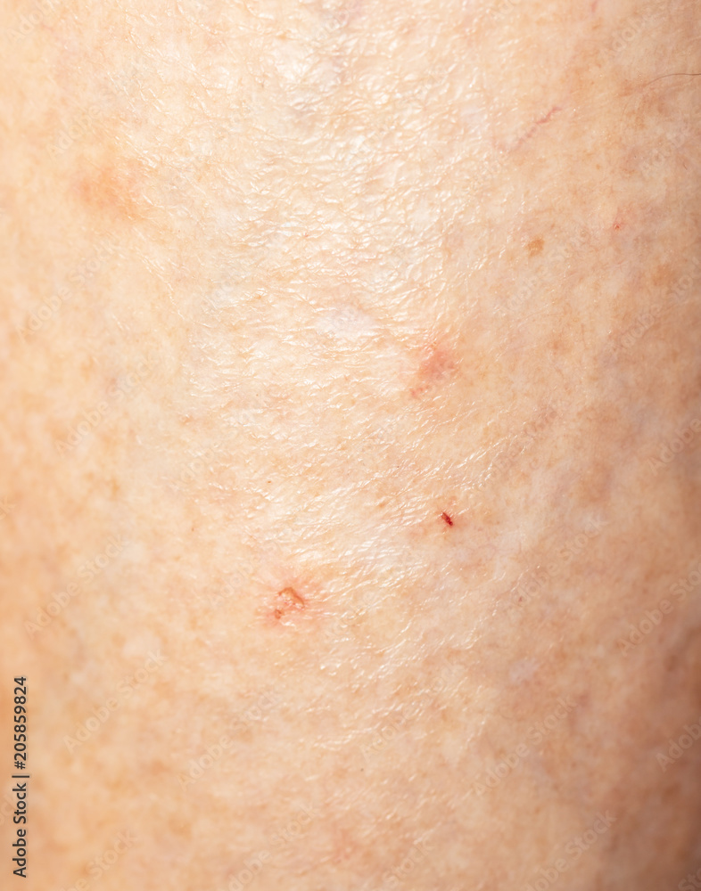mosquito bites on the leg mosquito bites on the leg