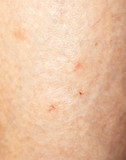 mosquito bites on the leg