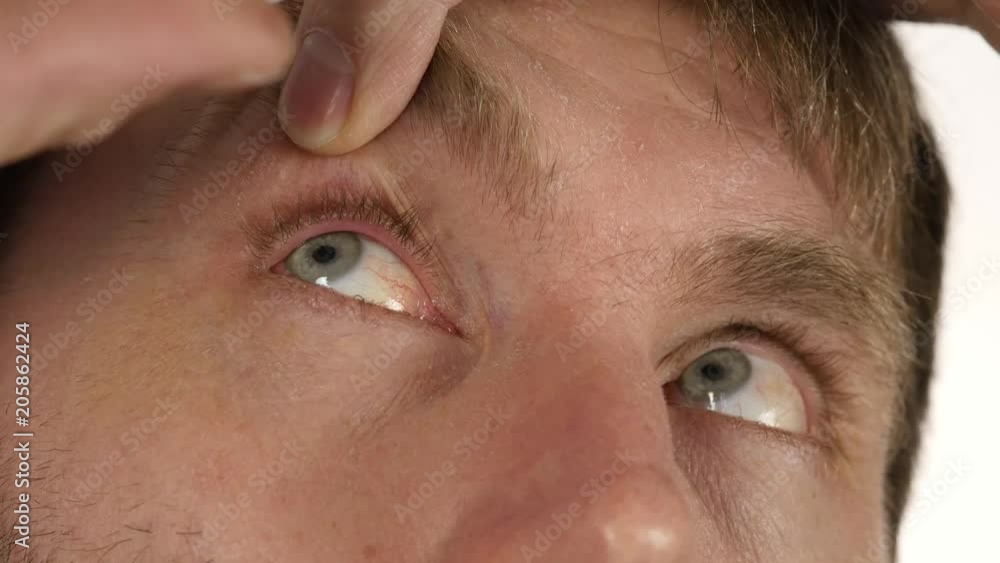 hordeolum disease in the eye, man dripping treatment drops to his eye. infection and