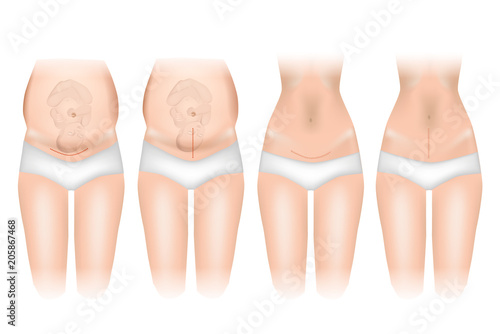 Types of incisions in cesarean delivery. Sutures after cesarean section. Vector illustration.