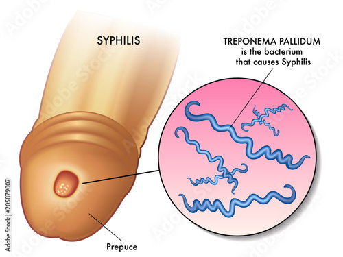vector medical illustration of a penis with a syphilis papule on the glans caused by the bacterium treponema pallidum