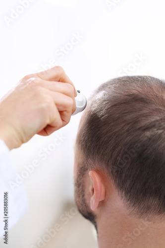 Wypadanie włosów. Mężczyzna u lekarza. Głowa mężczyzny z przerzedzonymi włosami podczas badania skóry głowy i włosów mikroskopem 