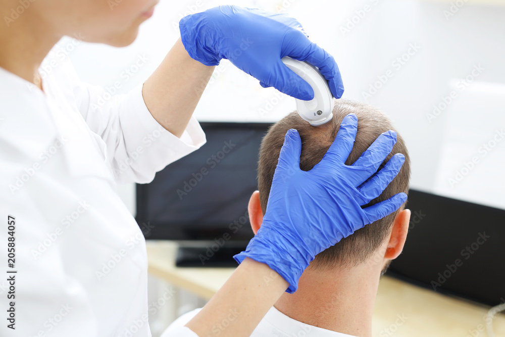 Trycholog. Wypadanie włosów. Mężczyzna u lekarza. Głowa mężczyzny z przerzedzonymi włosami podczas badania skóry głowy i włosów mikroskopem - obrazy, fototapety, plakaty 