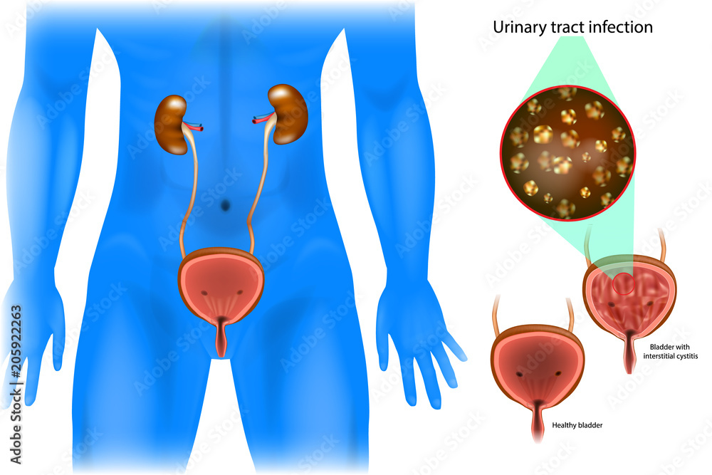 Urinary tract infection. Bladder with interstitial cystitis and healthy ...