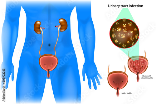 Urinary tract infection. Bladder with 
interstitial cystitis and healthy bladder.