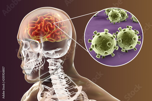 Viral meningitis and encephalitis, medical concept, 3D illustration showing brain infection and close-up view of viruses in the brain photo